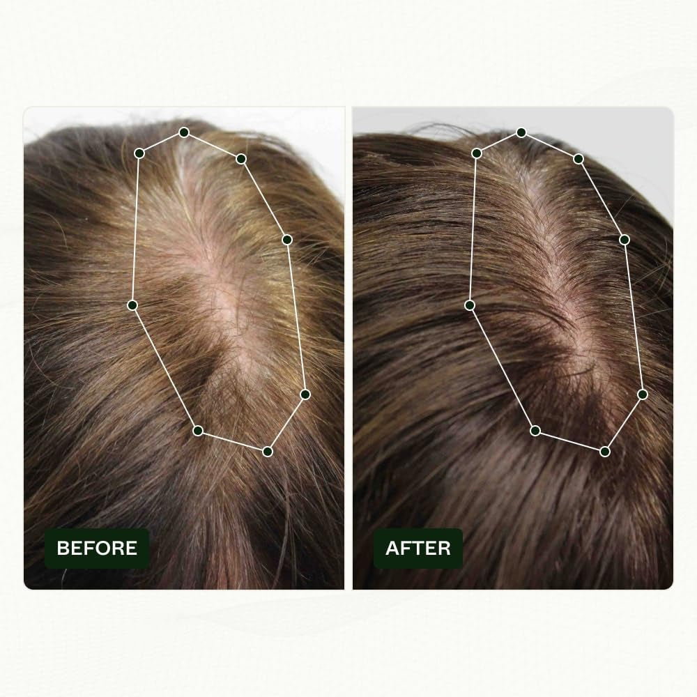 Scandinavian Biolabs Hair Growth Routine pentru femei cu rezultate dovedite clinic în 45 de zile | Tratamentul pentru căderea părului (Bio-Pilixin) Ingrijirea parului Naty Shop